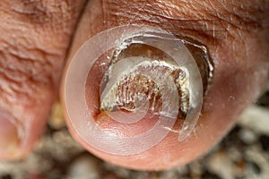 Candida Albicans toenail