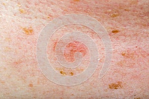 Infekce na člověk kůže 