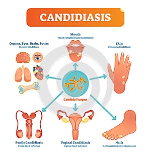 Candidiasis medical vector illustration diagram poster with all types of candida fungus on various human body parts and organs.