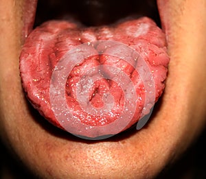 Candidiasis in the tongue. White coating. Fractured tongue. Thrush.