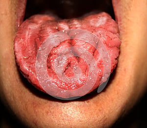 Candidiasis in the tongue. White coating. Fractured tongue. Thrush. photo