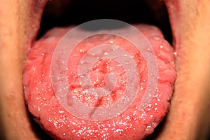 Candidiasis in the tongue. White coating. Thrush.