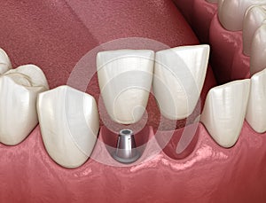Cantilever bridge implant based, frontal tooth recovery. Medically accurate 3D animation of dental concept