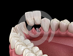 Cantilever bridge implant based, frontal tooth recovery. Medically accurate 3D animation of dental concept