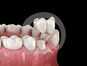 Cantilever bridge made from ceramic, frontal tooth recovery. Medically accurate 3D animation of dental concept