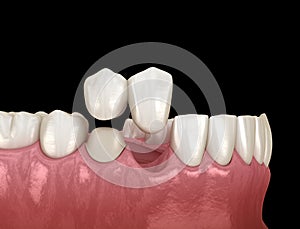 Cantilever bridge made from ceramic, frontal tooth recovery. Medically accurate 3D animation of dental concept