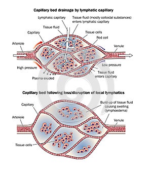Capillary bed lymphoedema photo