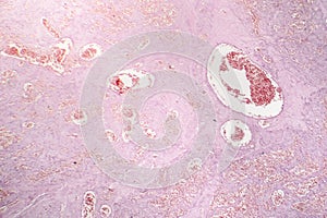 Capillary hemangioma, light micrograph