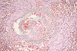 Capillary hemangioma, light micrograph