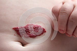 Capillary hemangioma red birthmark on the baby`s belly