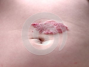 Capillary hemangioma regression. Red birthmark on the baby`s belly after treatment photo