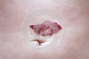 Capillary hemangioma regression. Red birthmark on the baby`s belly after treatment photo