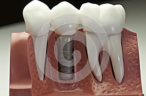 Limitovaný zubný implantát 
