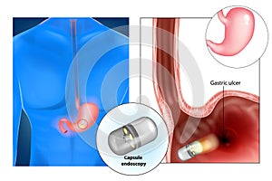 Capsule endoscopy aka pill cam photo