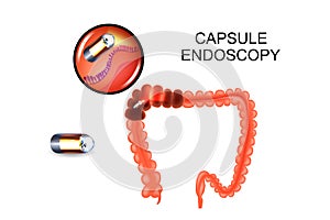 Capsule endoscopy of the colon