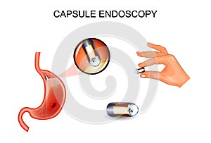 Capsule endoscopy. EGD, gastroenterology. photo