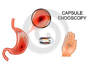 Capsule endoscopy, EGD, gastroenterology. photo