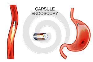Capsule endoscopy. EGD, gastroenterology. photo