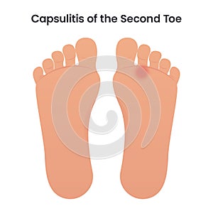 Capsulitis of the Second Toe medical vector illustration graphic photo