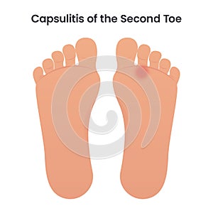 Capsulitis of the Second Toe medical vector illustration graphic