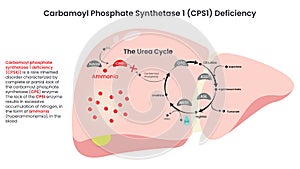 Carbamoyl Phosphate Synthetase (CPS1) Deficiency vector illustration