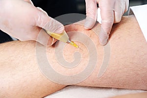 Carbon dioxide therapy carboxytherapy. Skin rejuvenation.The procedure is performed on the male knee.