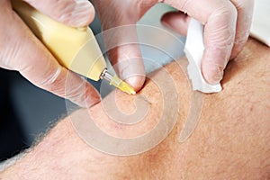 Carbon dioxide therapy carboxytherapy. Skin rejuvenation.The procedure is performed on the male knee.