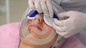 Carbon face peeling procedure.