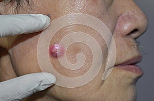 Carbuncle or nodular acne in face