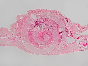 Carcinoid tumor 10X