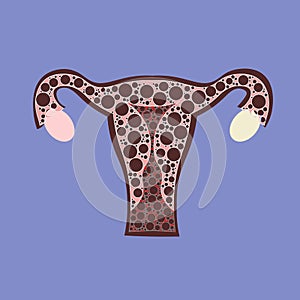 Malignant neoplasm arising from cells in the cervix uteri.