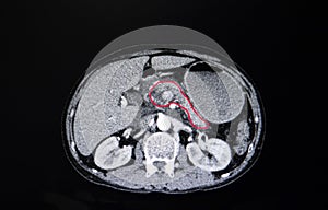 carcinoma of the head of pancreas