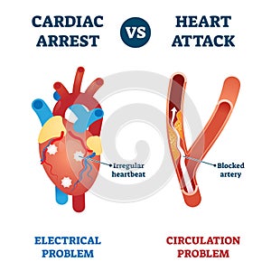 Cardiac arrest vs heart attack vector illustration. Labeled health problem.