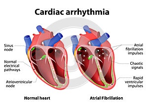 Cardiac arrhythmia photo