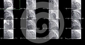 Cardiac catheterization can help doctor diagnose and treat problems in your heart and blood vessels that might otherwise cause