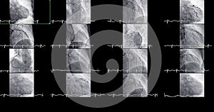 Cardiac catheterization can help doctor diagnose and treat problems in your heart and blood vessels that might otherwise cause