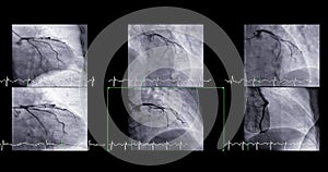 Cardiac catheterization can help doctor diagnose and treat problems in your heart and blood vessels that might otherwise cause