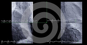 Cardiac catheterization can help doctor diagnose and treat problems in your heart and blood vessels that might otherwise cause