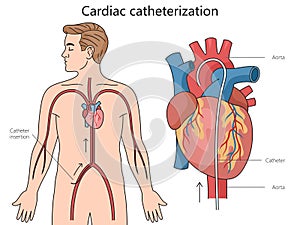 Cardiac catheterization diagram medical science