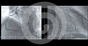 Cardiac catheterization on RCA and LAD can help doctor diagnose and treat problems in your heart and blood vessels  such as a