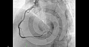 Cardiac catheterization on right coronary artery (RCA) .