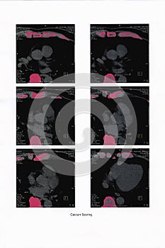Cardiac CT image report for Calcium Scoring