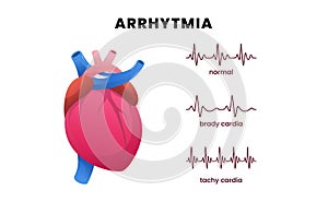 Cardiac disease arrhythmia with a heart and pulse ECG, showcasing normal heart rhythm, bradycardia or slow heart rate, and photo