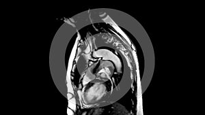 Cardiac MRI of heart in sagittal view showing heart beating.