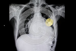 a cardiac pacemaker