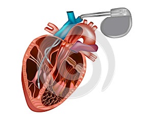 Cardiac pacemaker or artificial pacemaker. photo