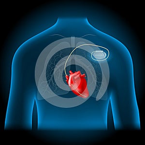 cardiac pacemaker location