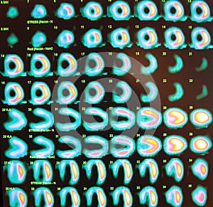 stress test,nuclear medicine photo