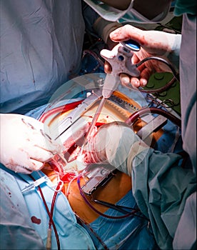 Cardiac surgery