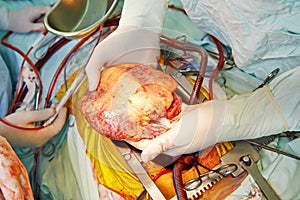 Cardiac surgery heart transplantation